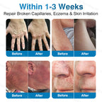🇦🇺👨‍⚕️✅⭐GFOUK® VeinRepair Microneedle Patch Roll⚡Instant Relief, Long-Term Results